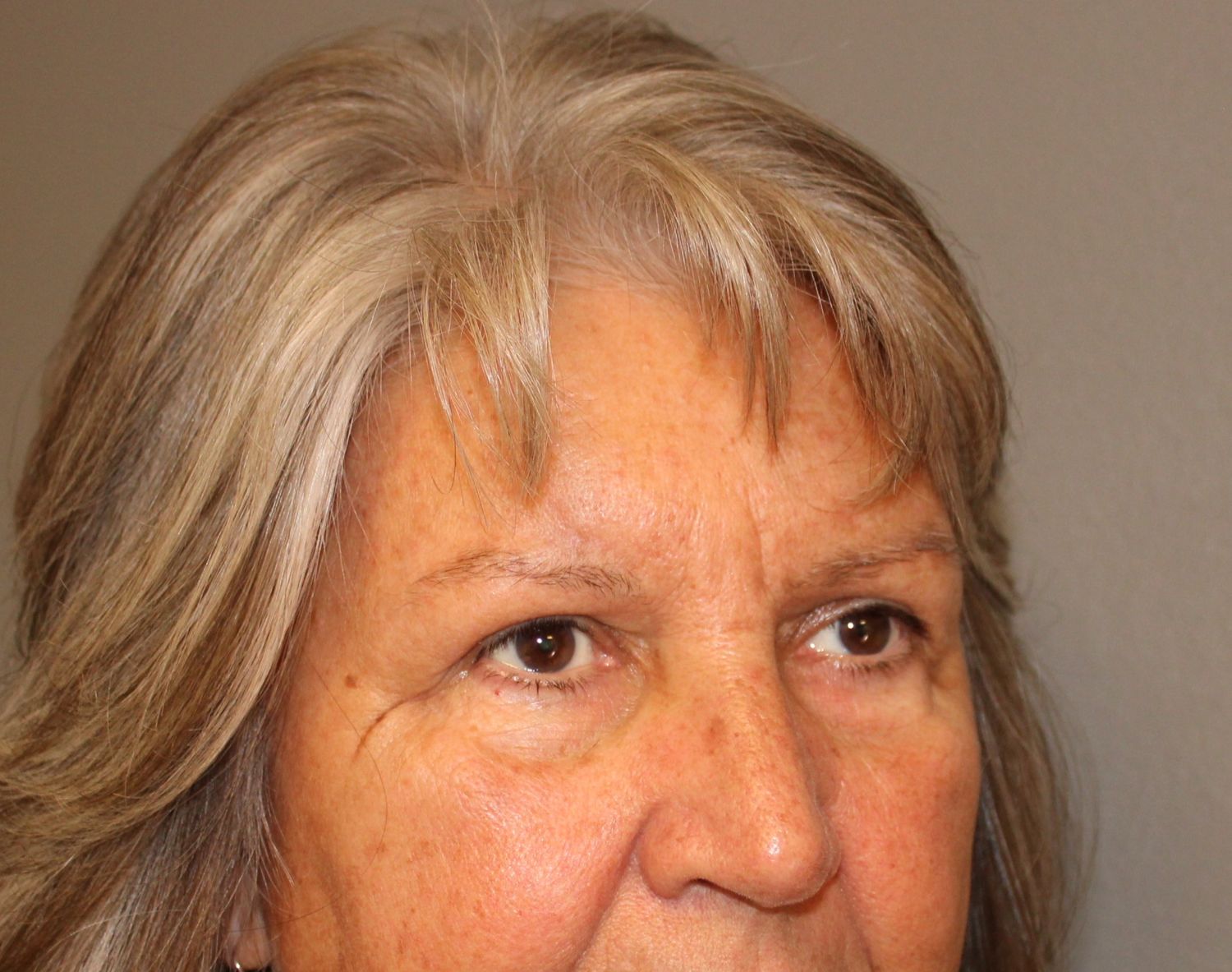 Blepharoplasty Before & After