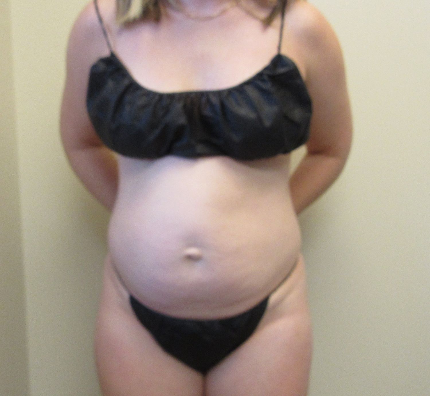 Tummy Tuck Before & After