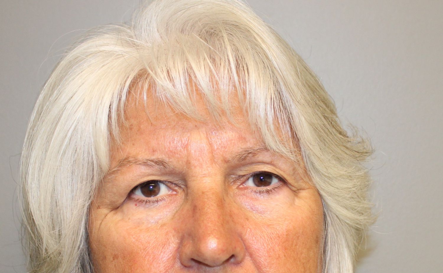 Blepharoplasty Before & After