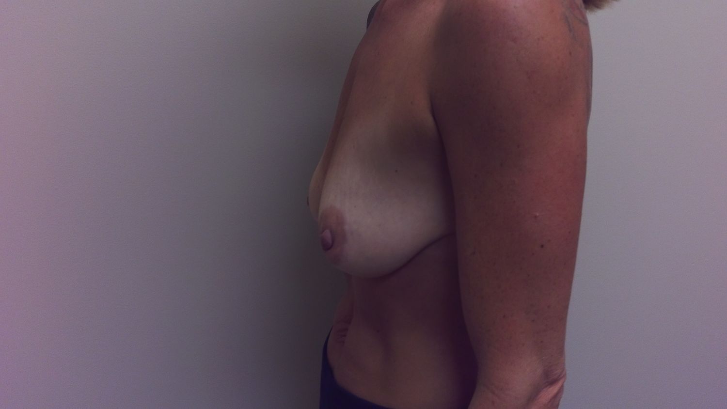 Breast Augmentation Before & After