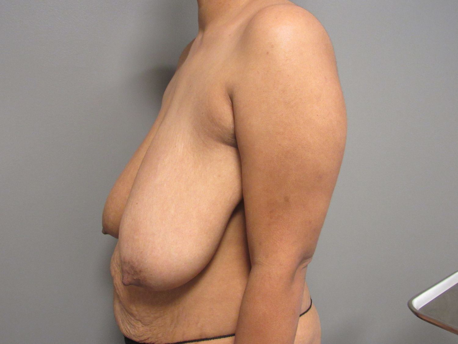 Breast Reduction Before & After