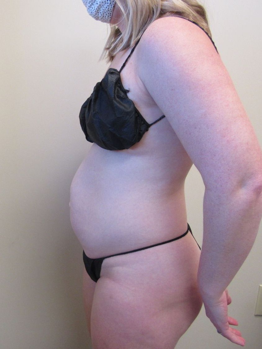 Tummy Tuck Before & After