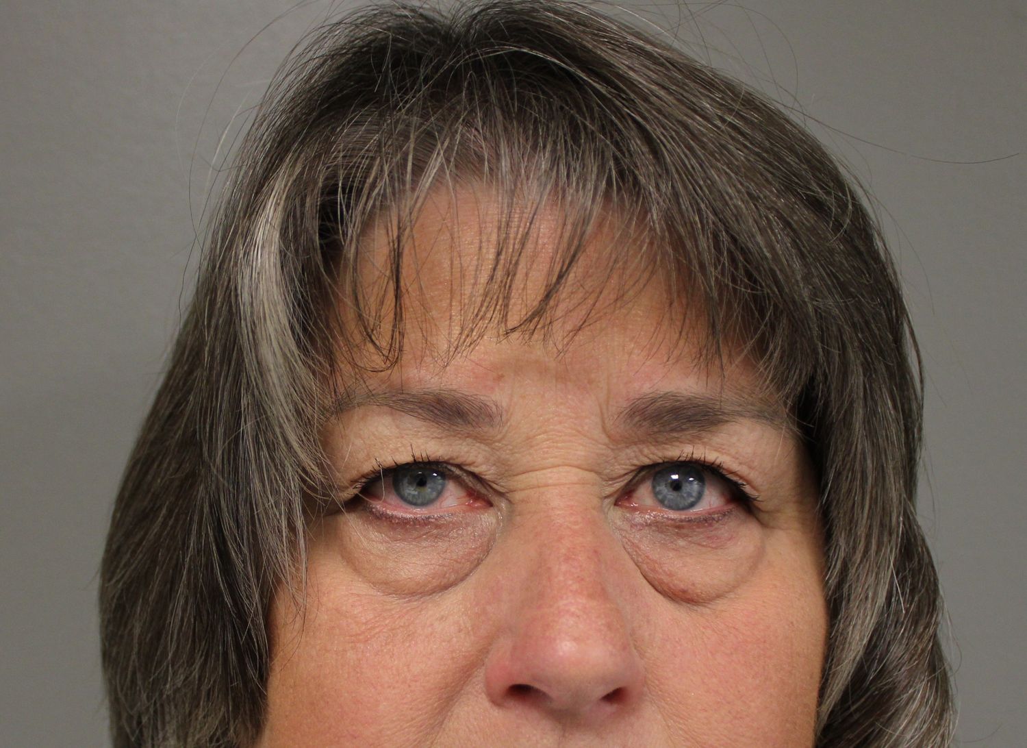 Blepharoplasty Before & After