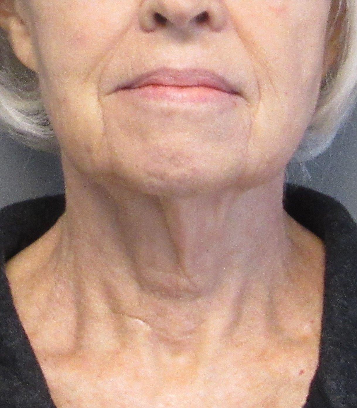 Facelift Before & After