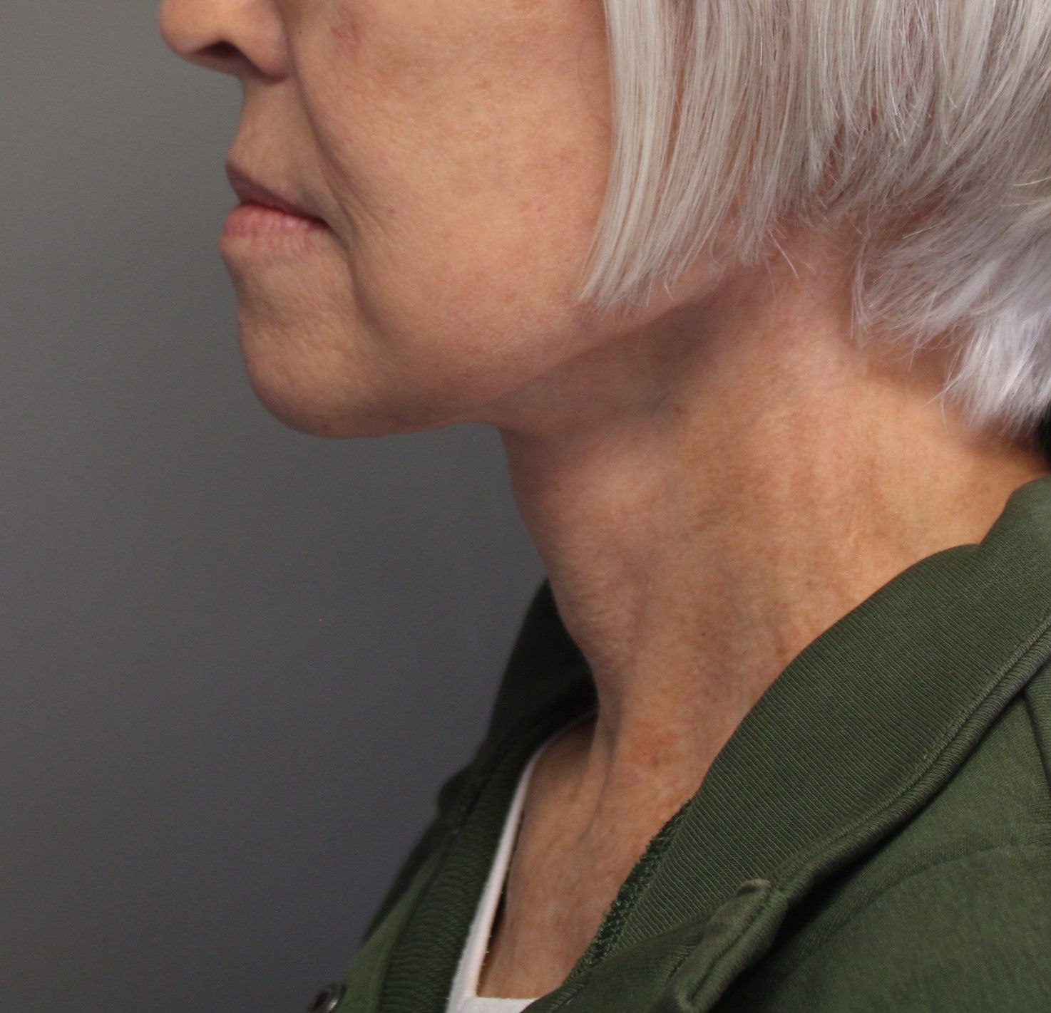 Facelift Before & After