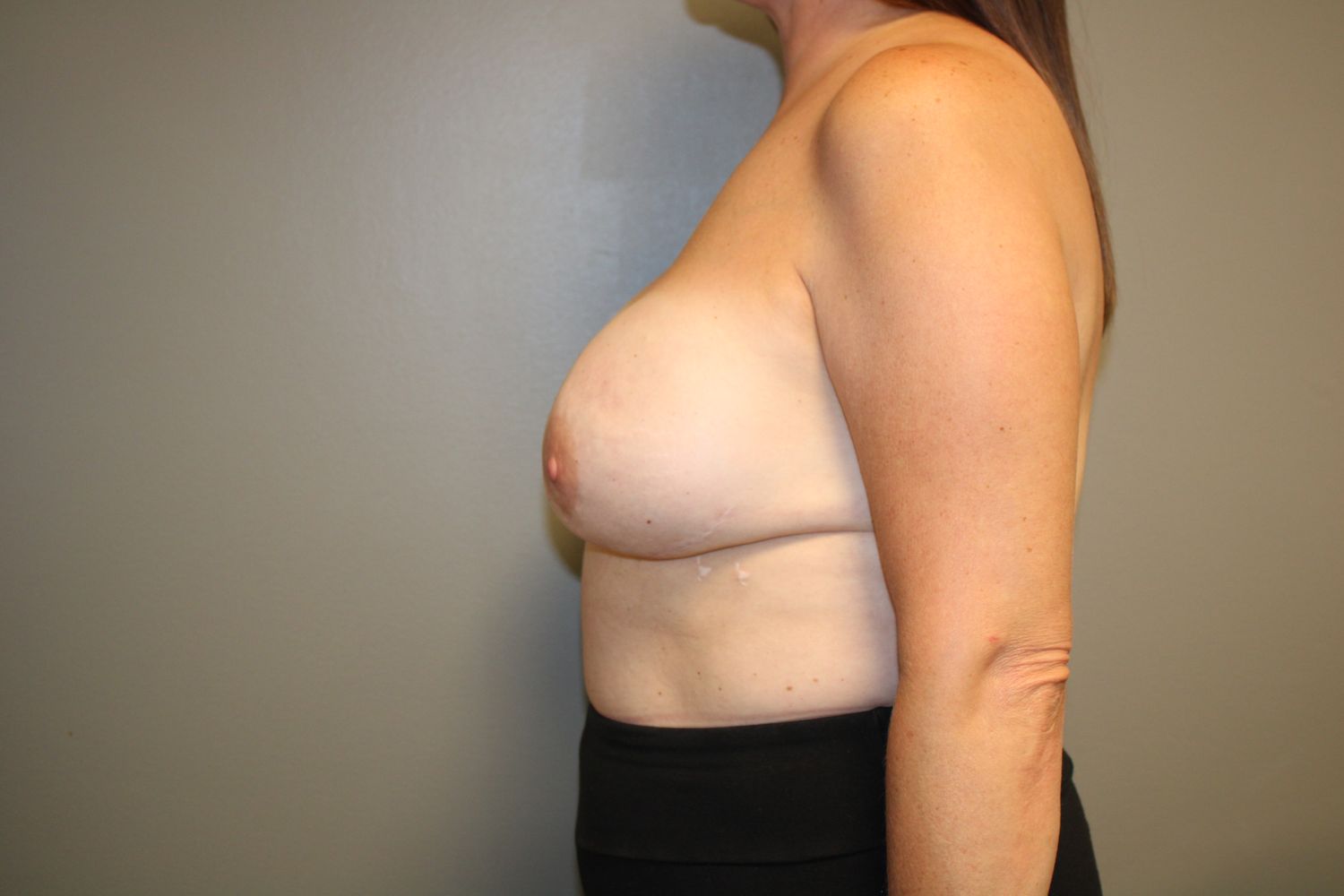 Breast Reconstruction Before & After