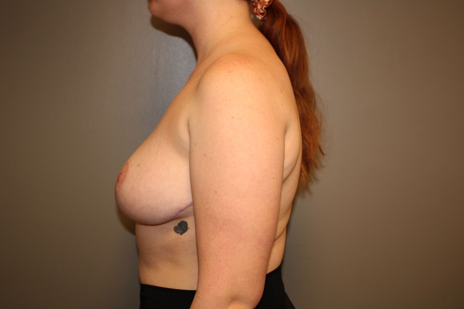 Breast Reduction Before & After