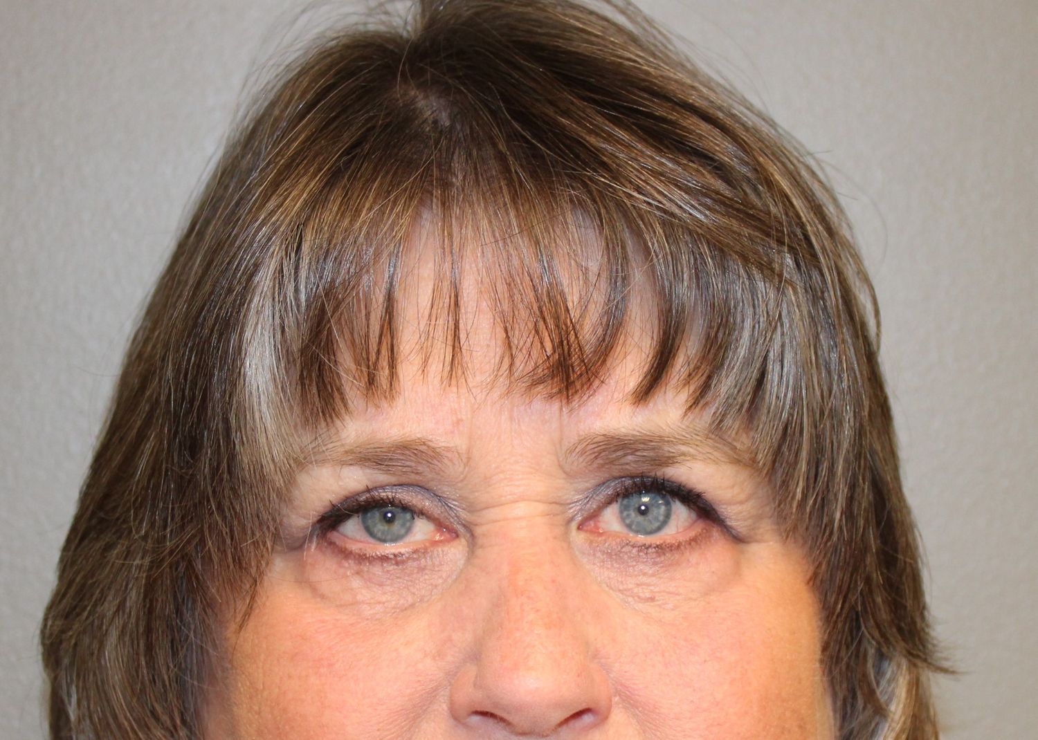 Blepharoplasty Before & After