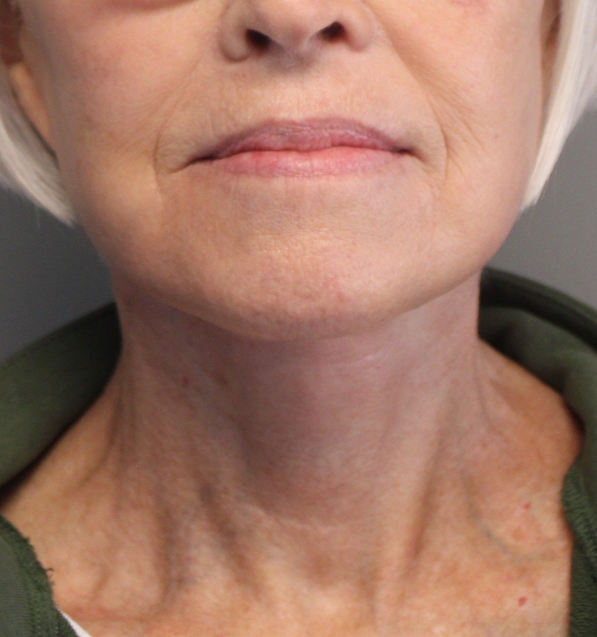 Facelift Before & After