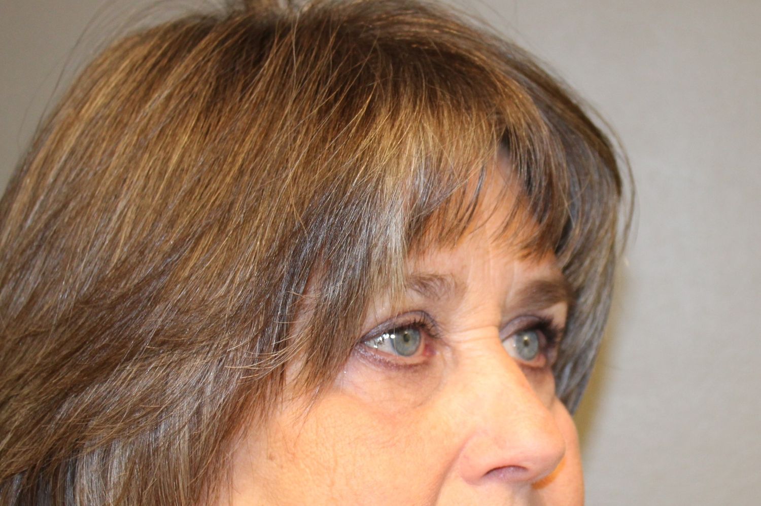 Blepharoplasty Before & After