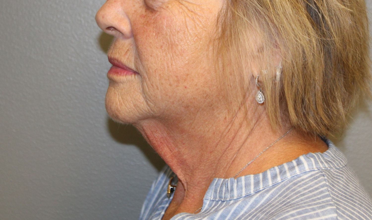 Facelift Before & After