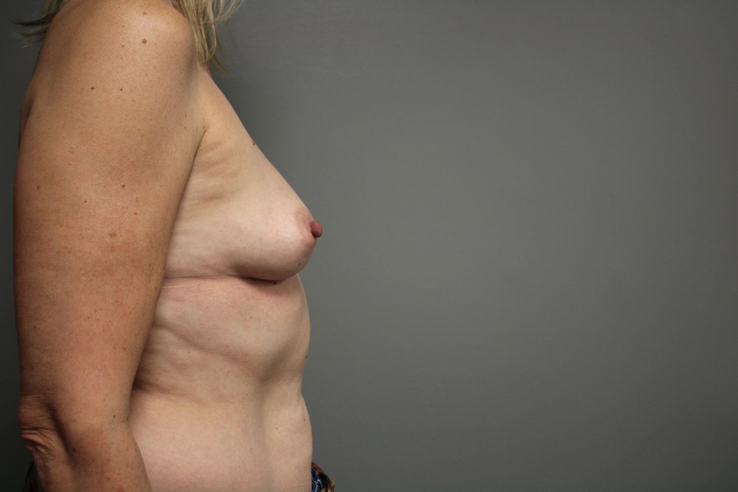 Breast Reconstruction Before & After