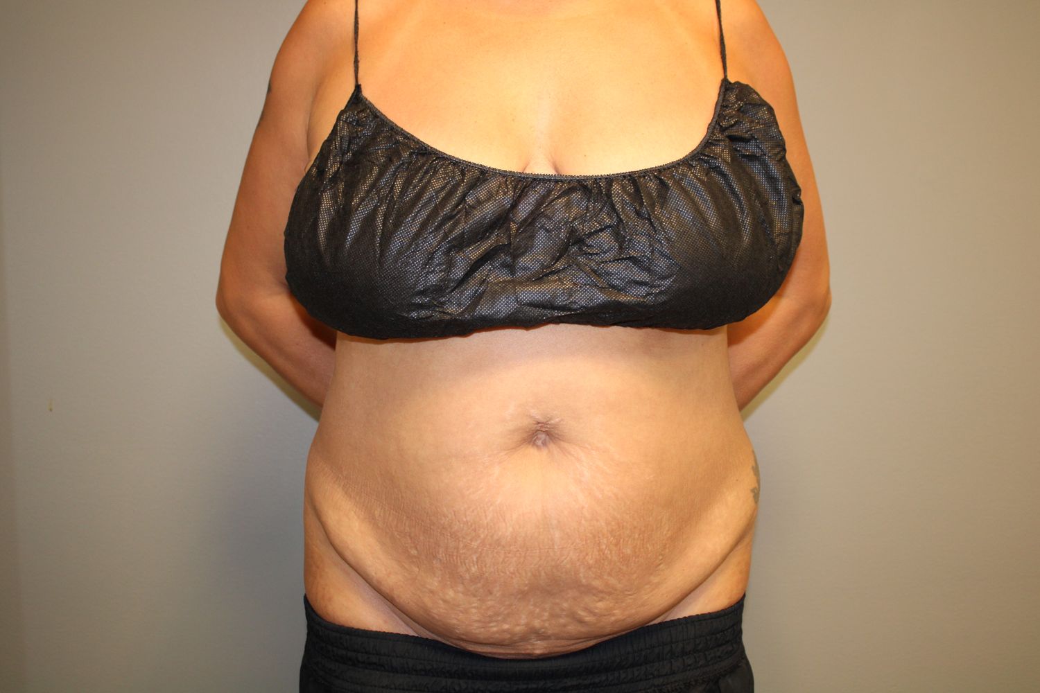 Tummy Tuck Before & After