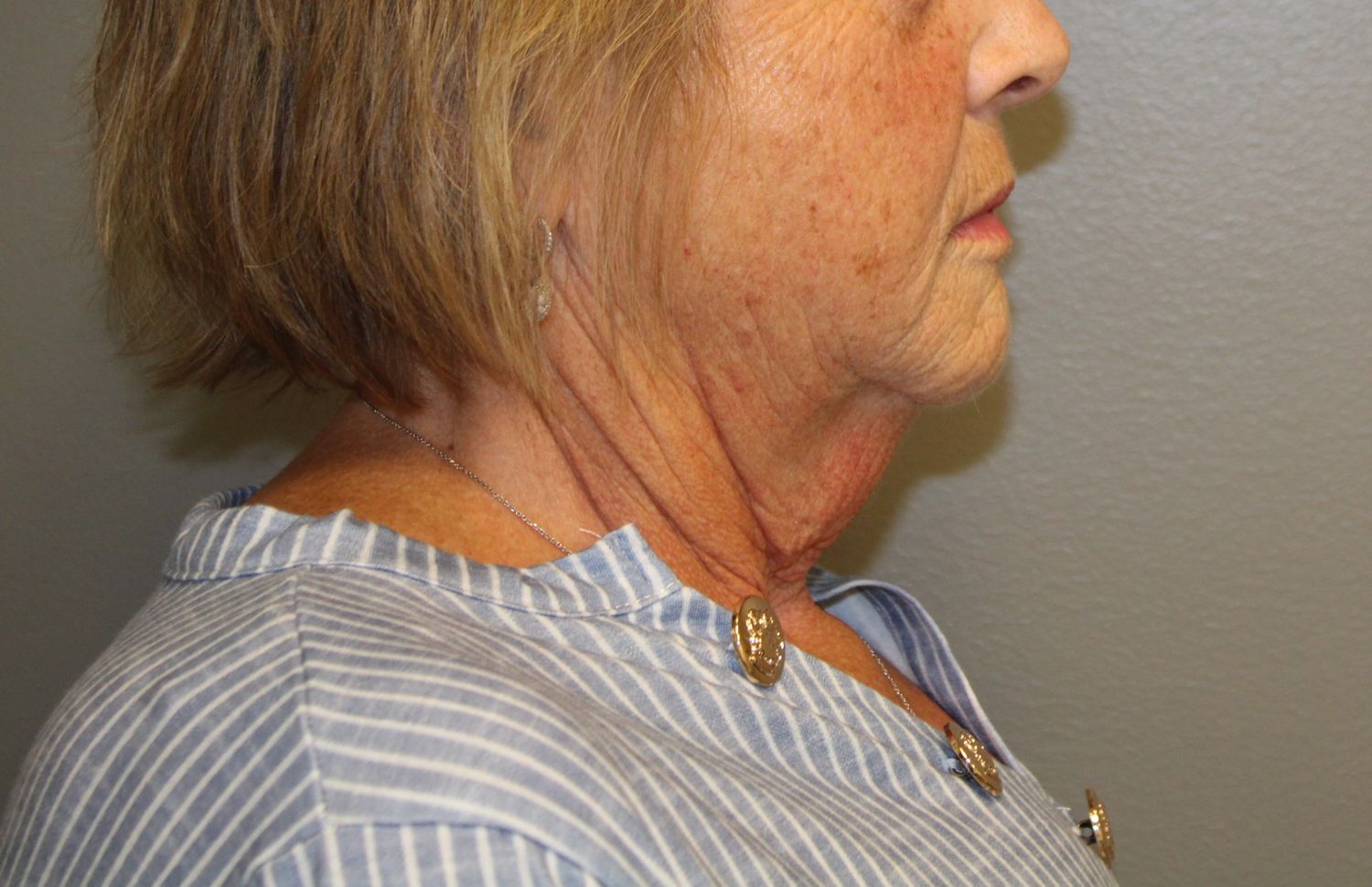 Facelift Before & After