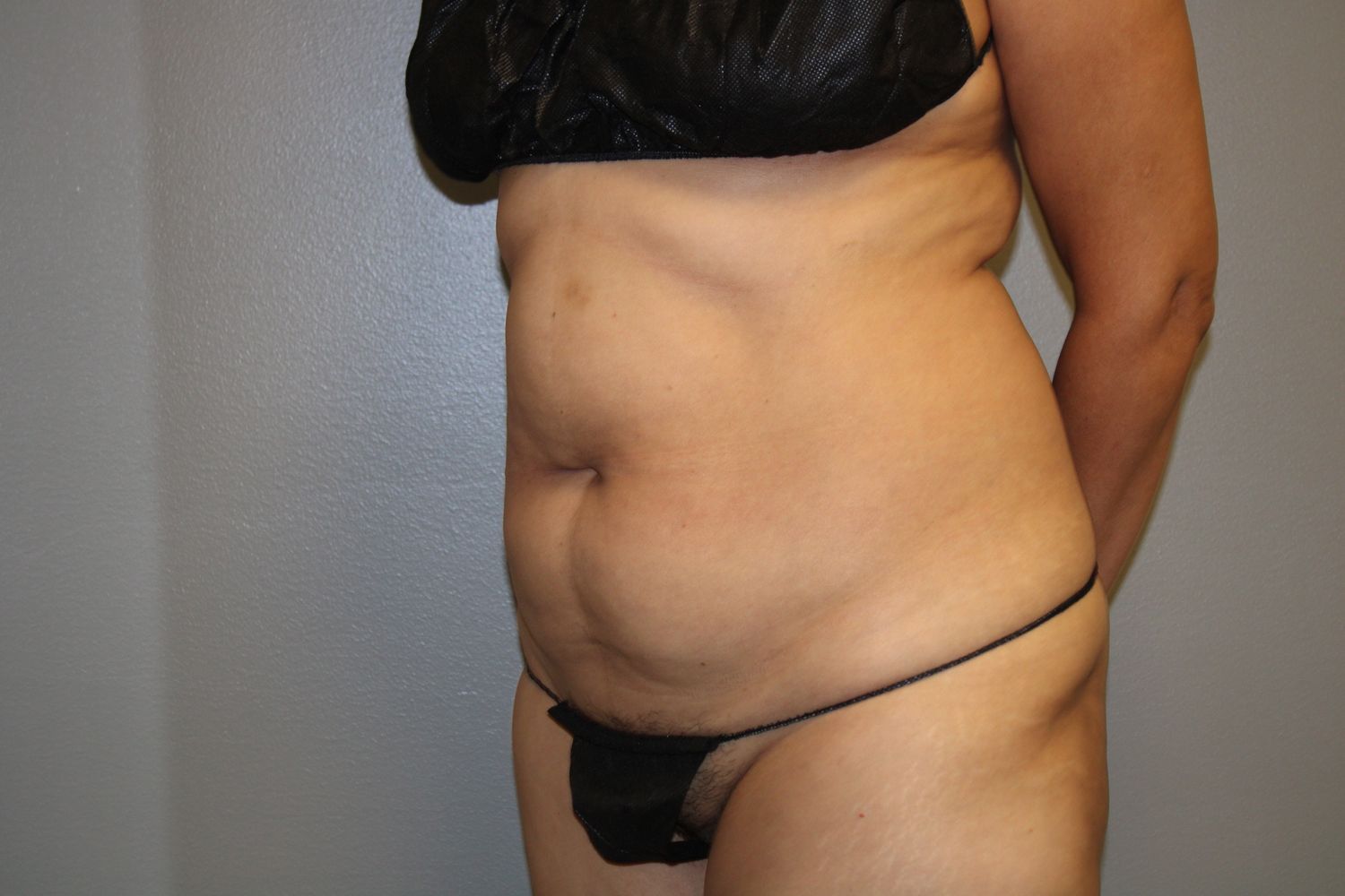 Tummy Tuck Before & After