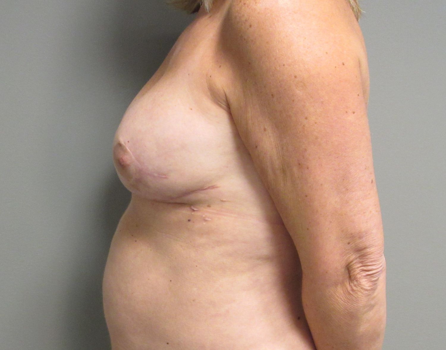 Breast Reconstruction Before & After