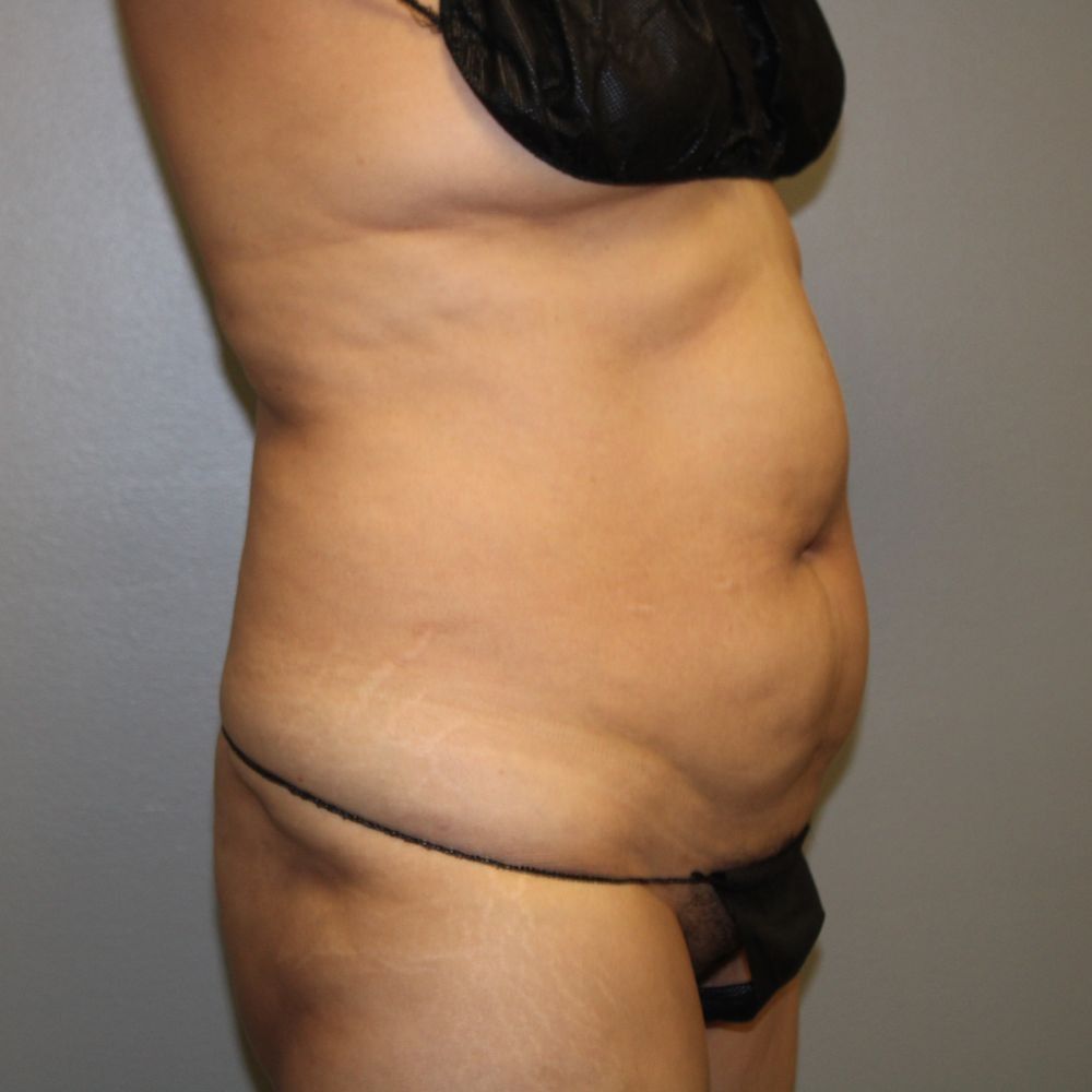 Tummy Tuck Before & After
