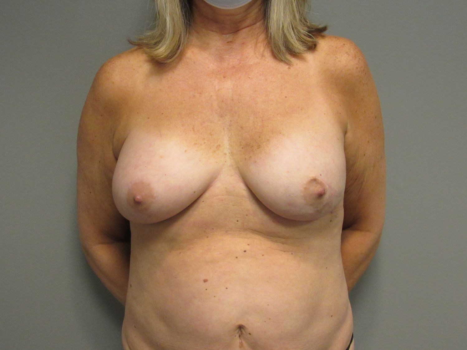 Breast Reconstruction Before & After