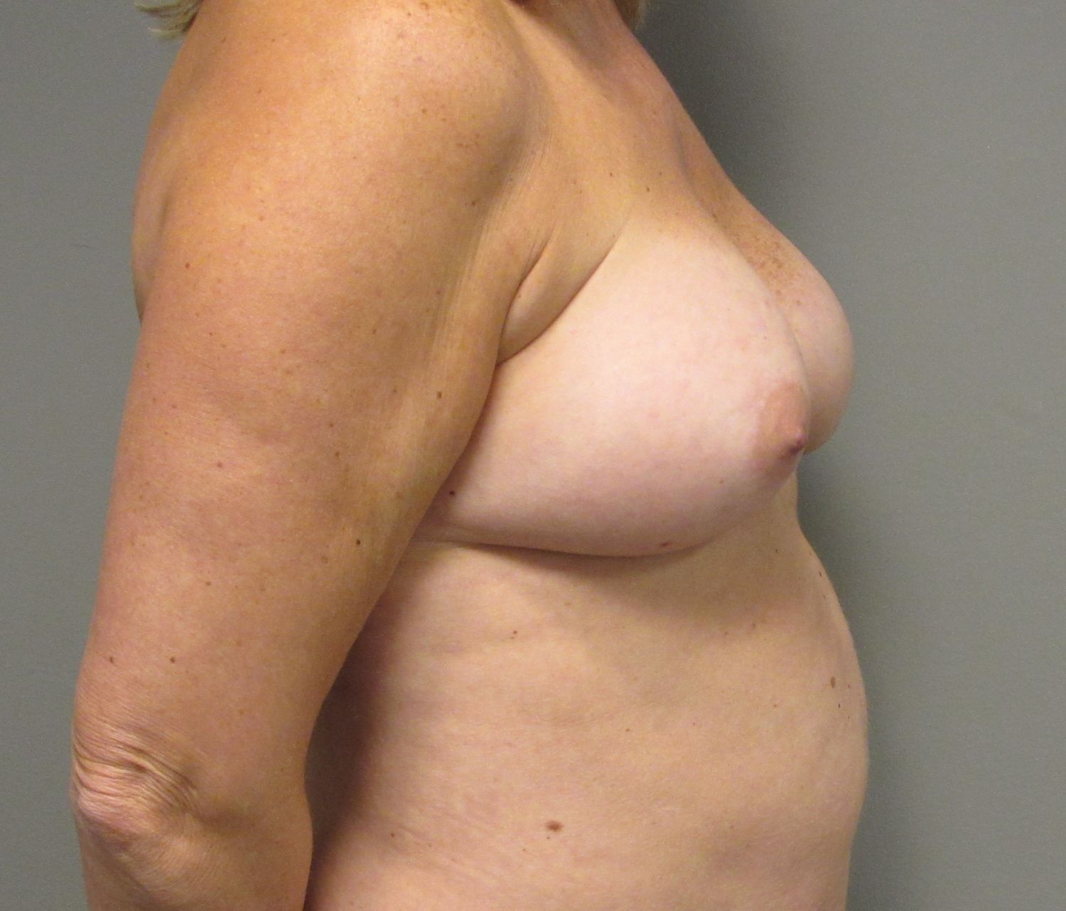 Breast Reconstruction Before & After