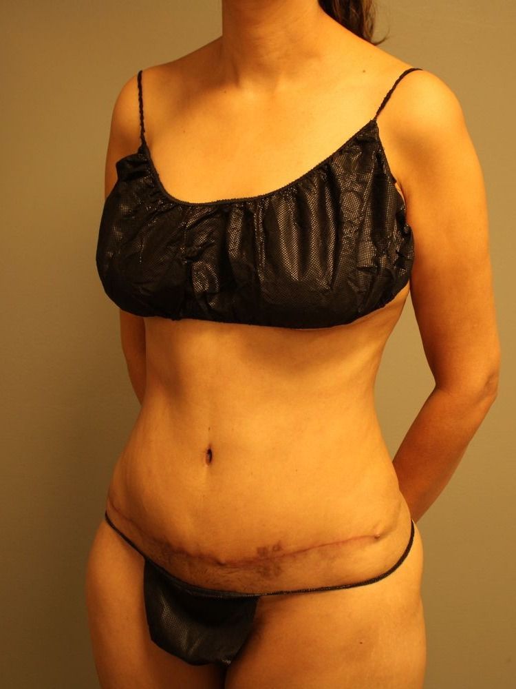 Tummy Tuck Before & After