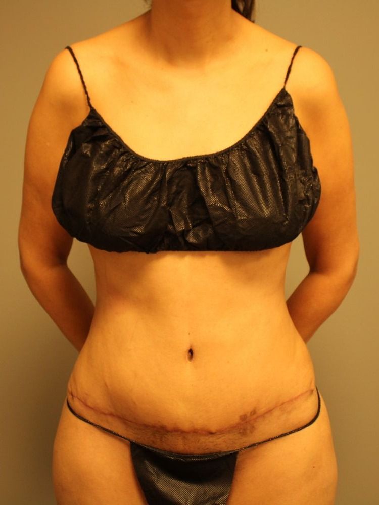 Tummy Tuck Before & After