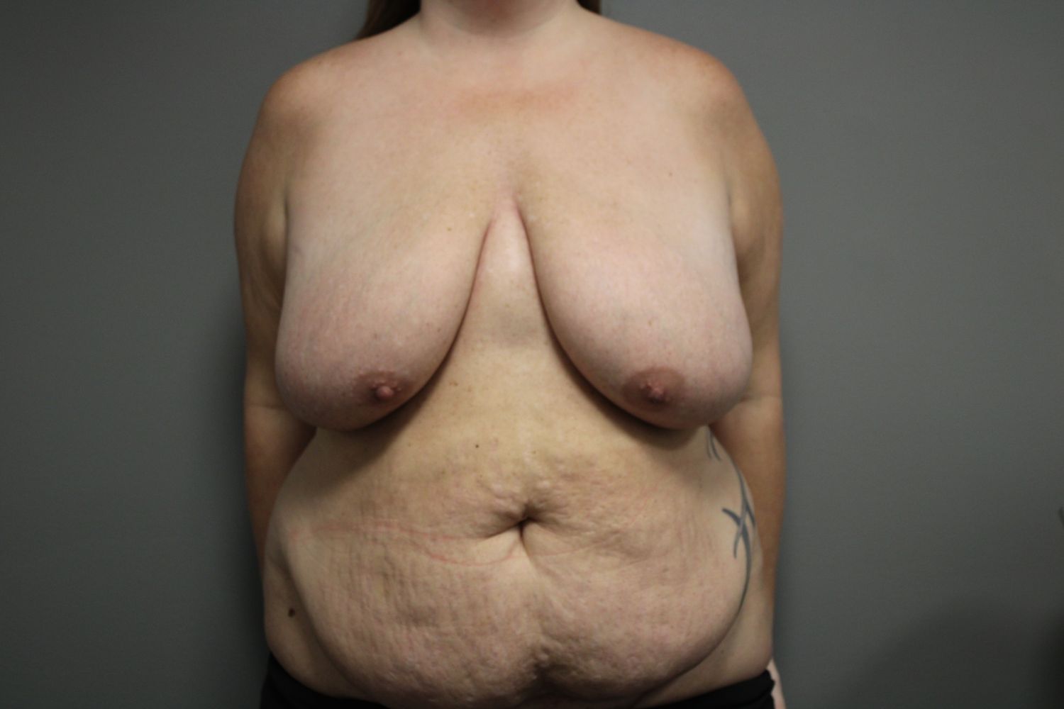 Tummy Tuck Before & After