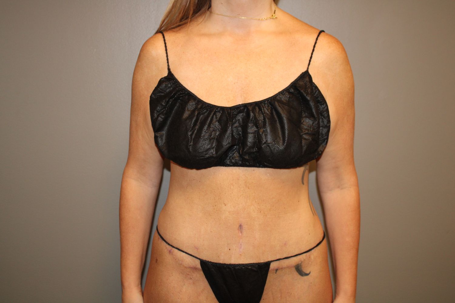 Tummy Tuck Before & After