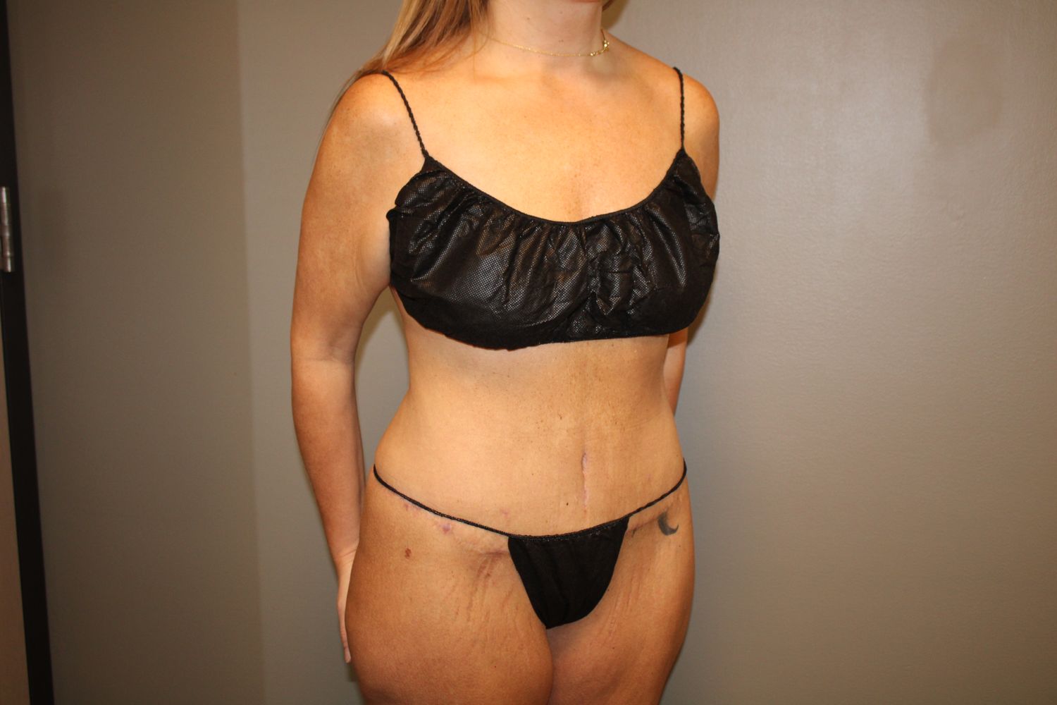 Tummy Tuck Before & After