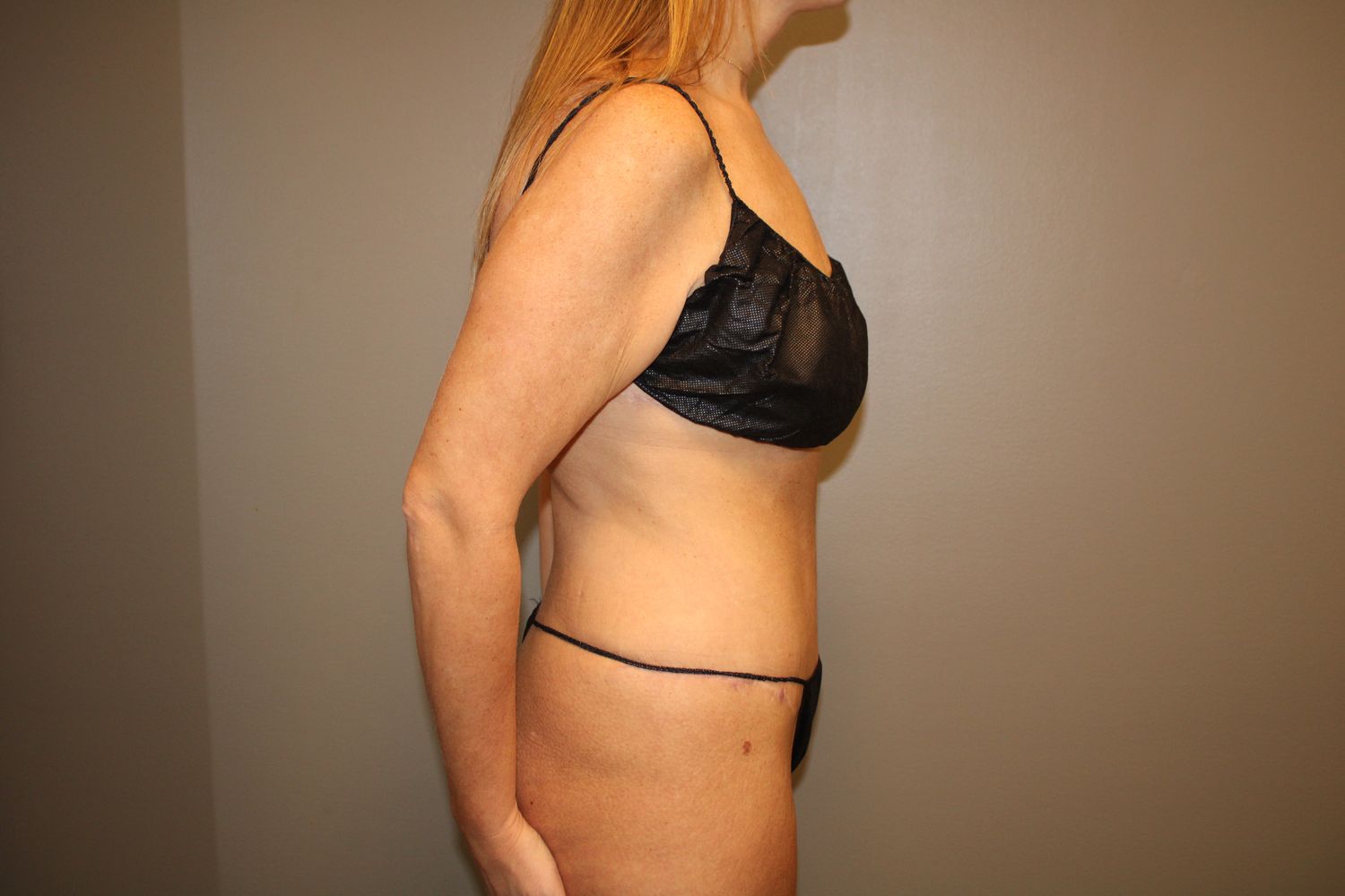 Tummy Tuck Before & After