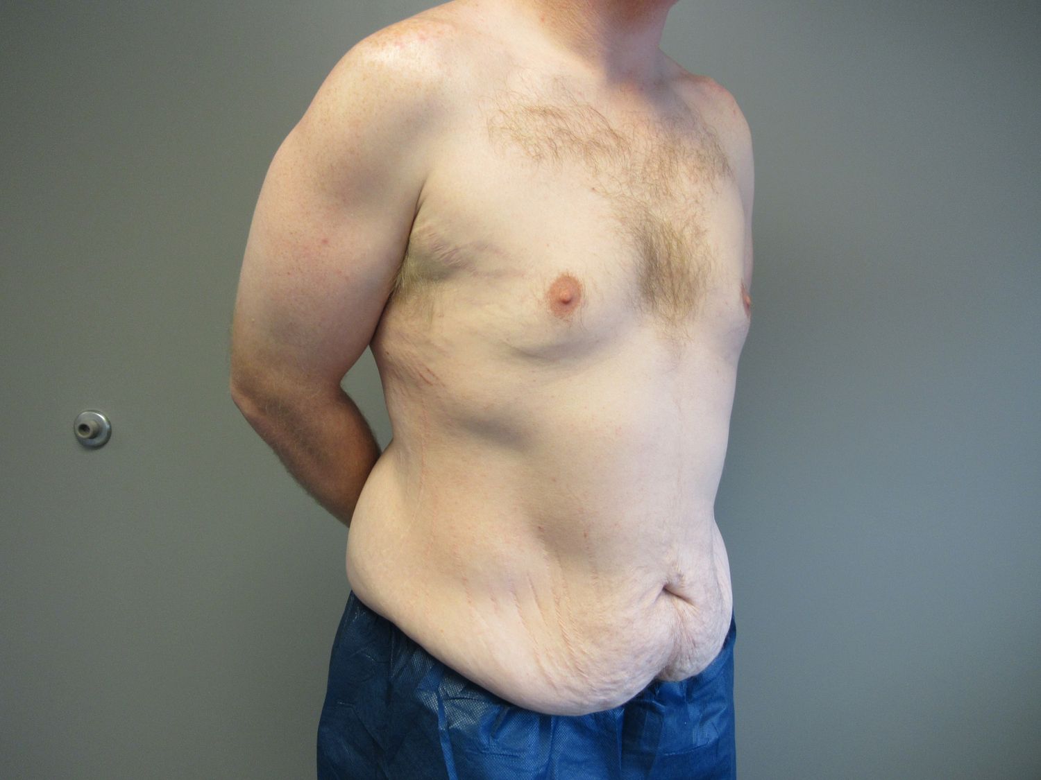 Tummy Tuck Before & After