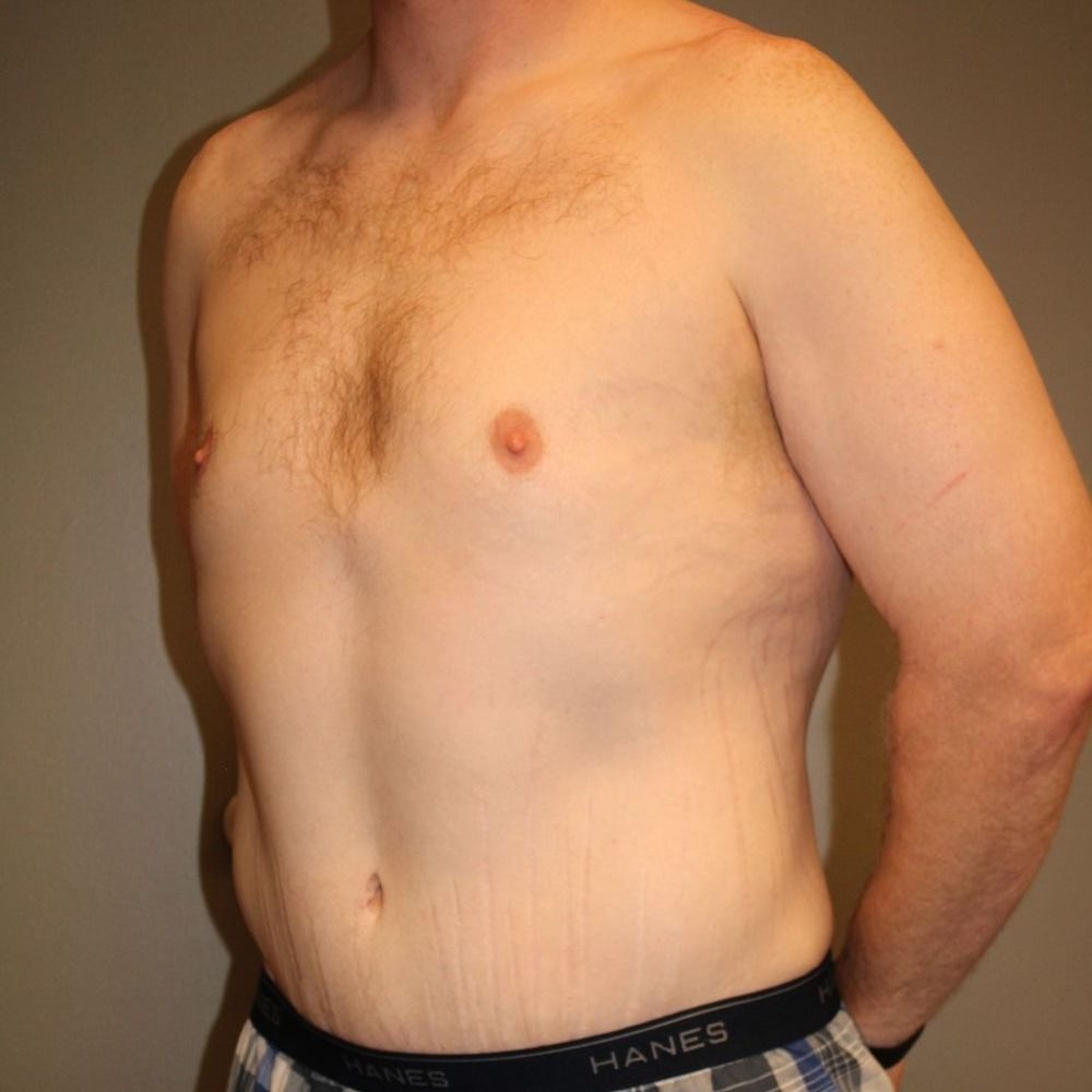 Tummy Tuck Before & After