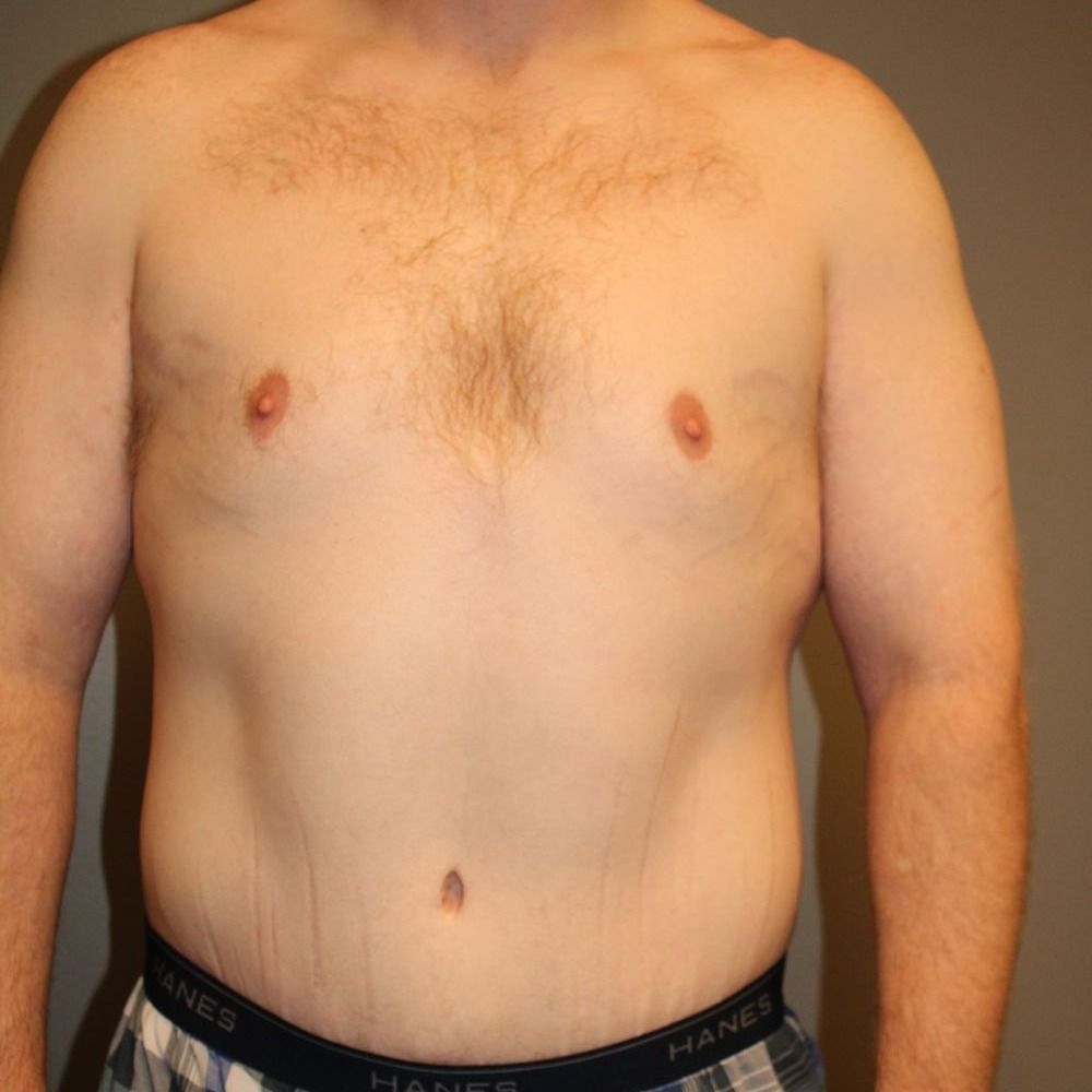 Tummy Tuck Before & After