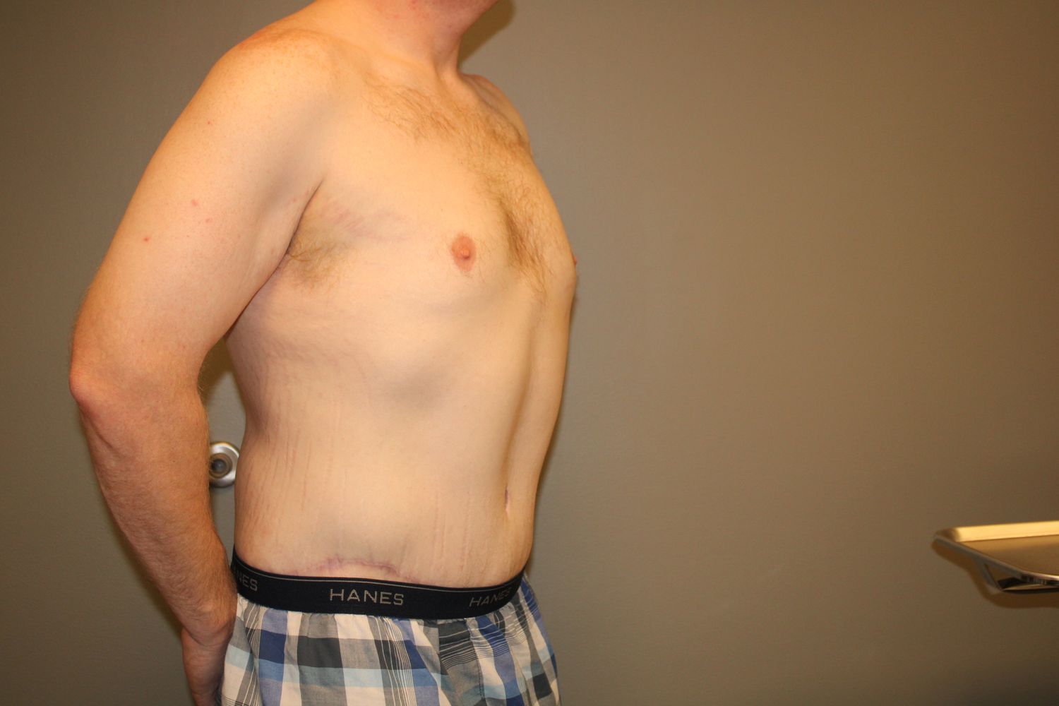 Tummy Tuck Before & After