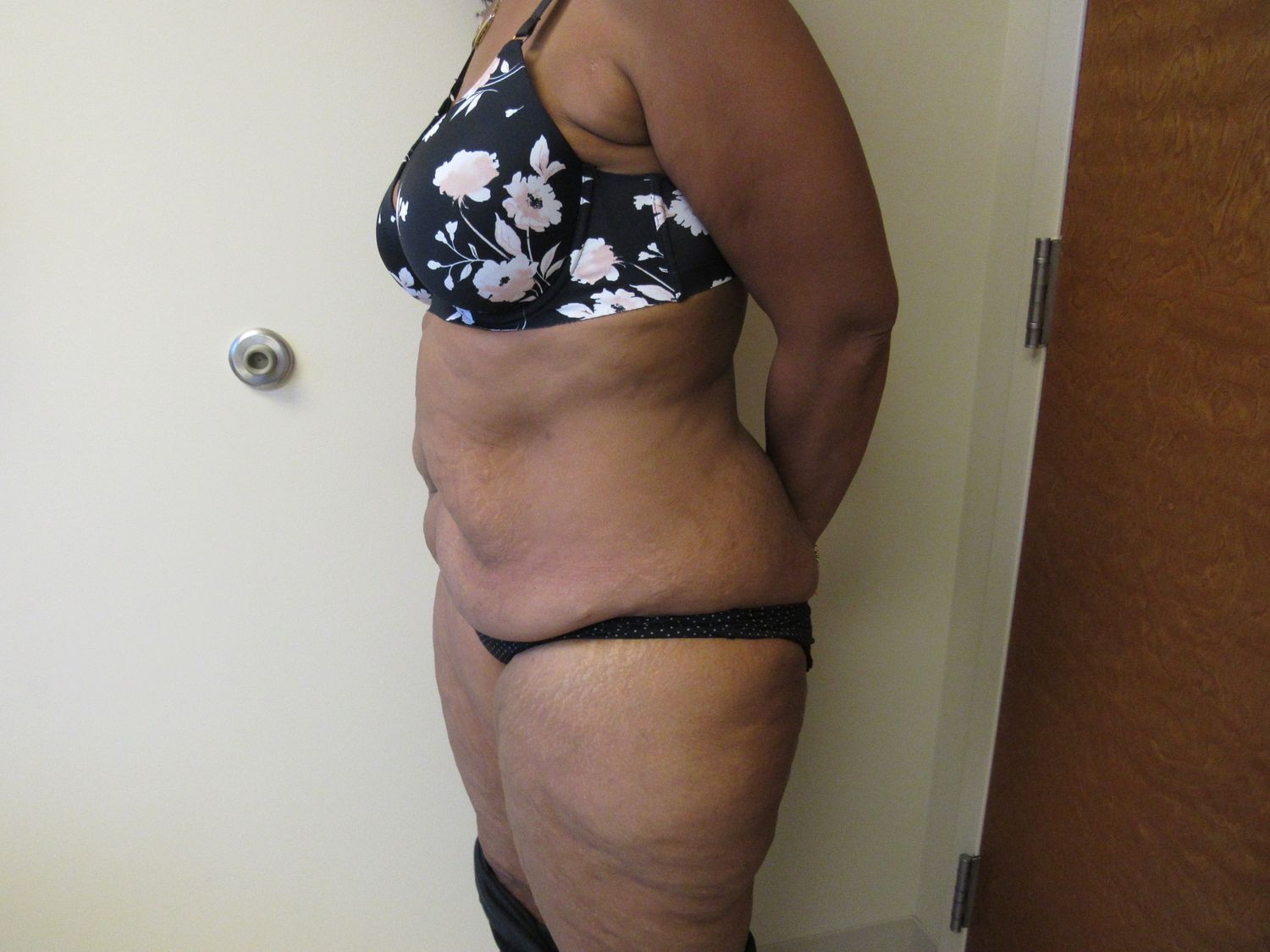 Tummy Tuck Before & After