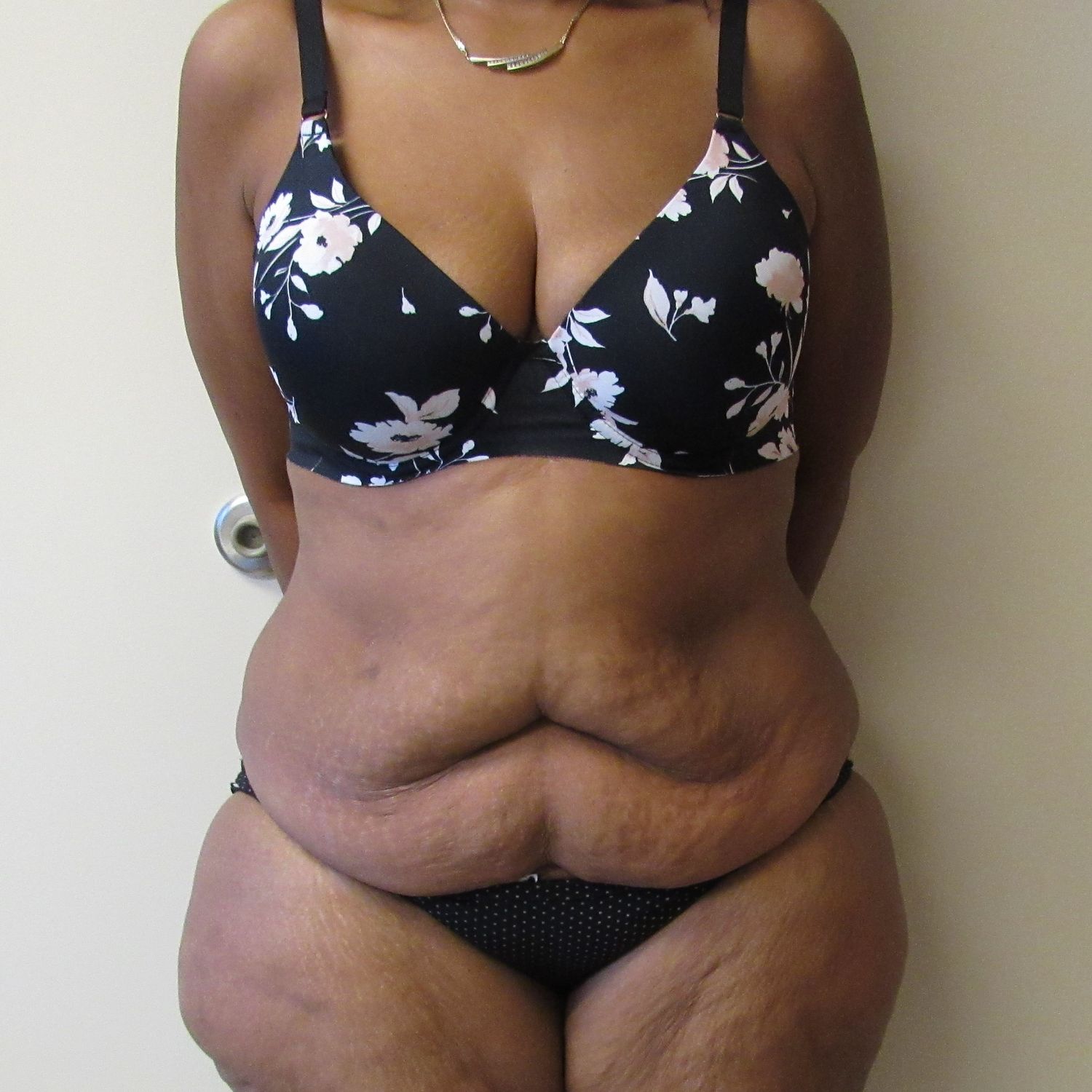 Tummy Tuck Before & After