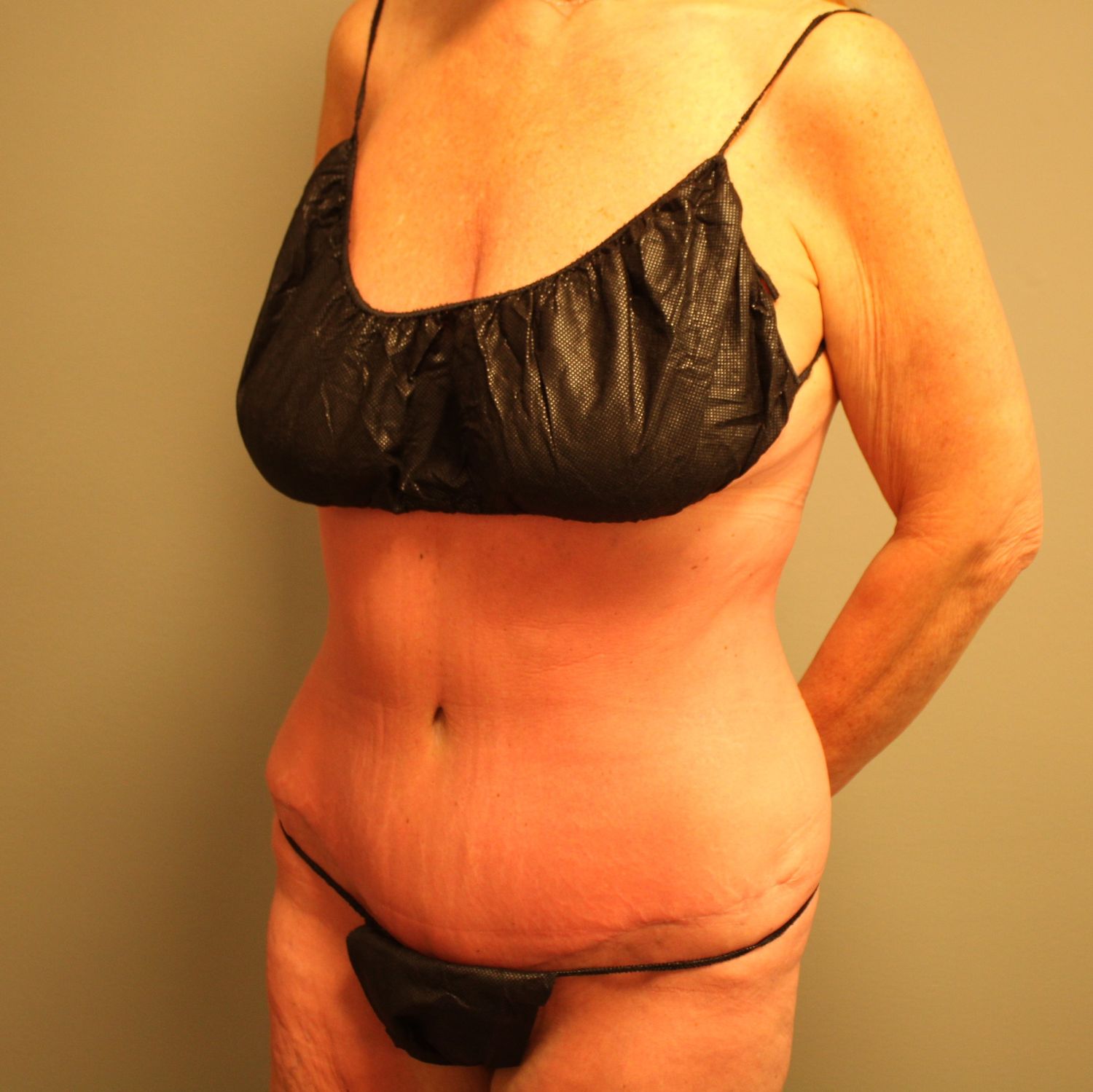 Tummy Tuck Before & After