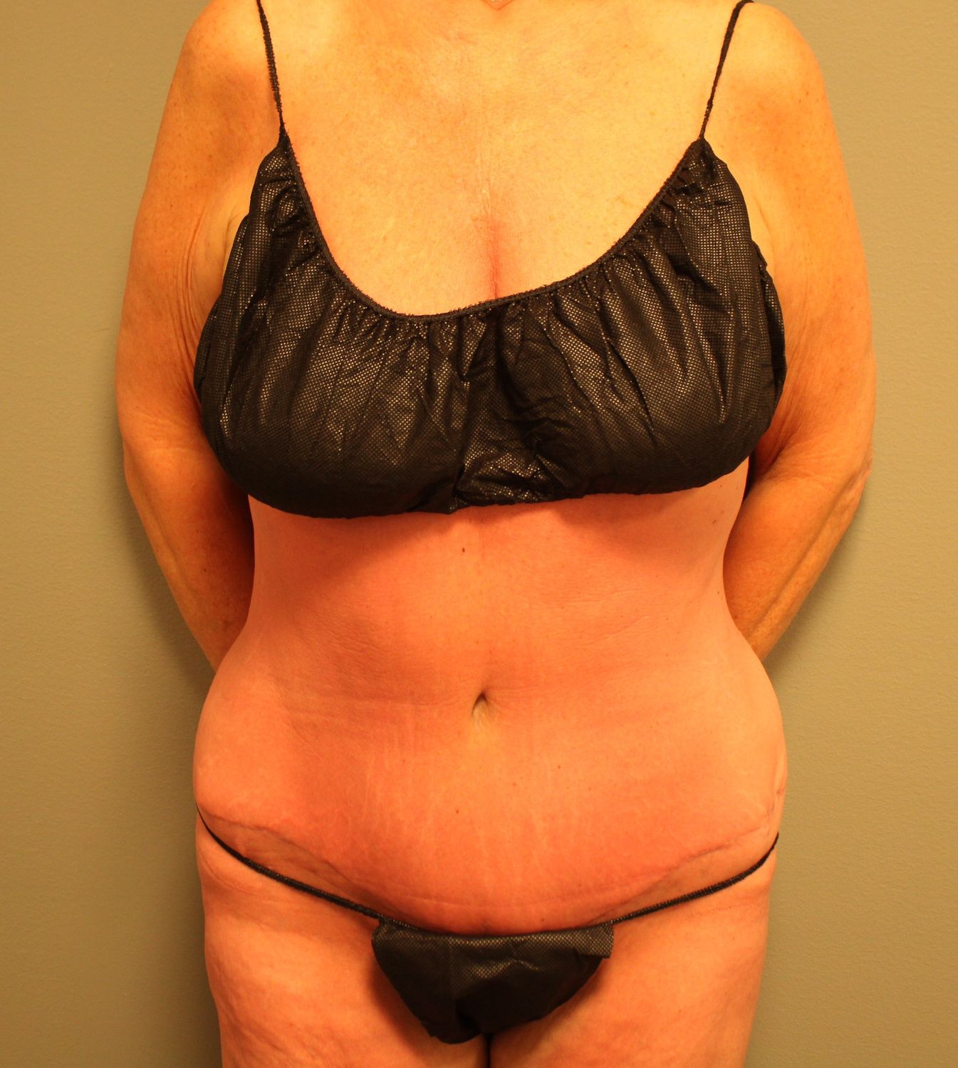 Tummy Tuck Before & After