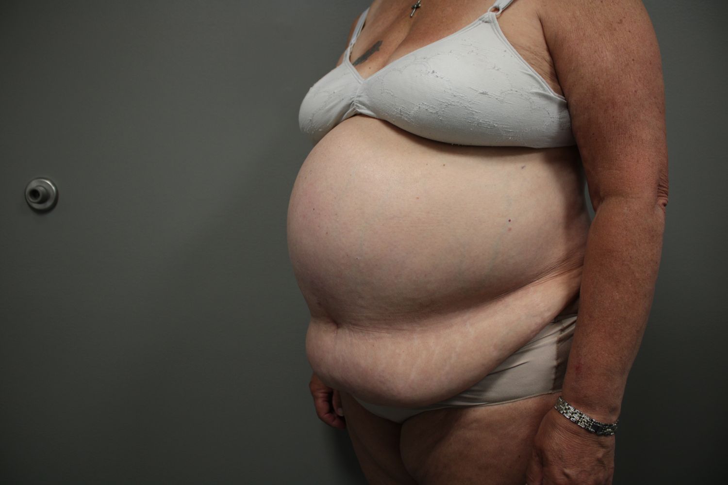 Tummy Tuck Before & After