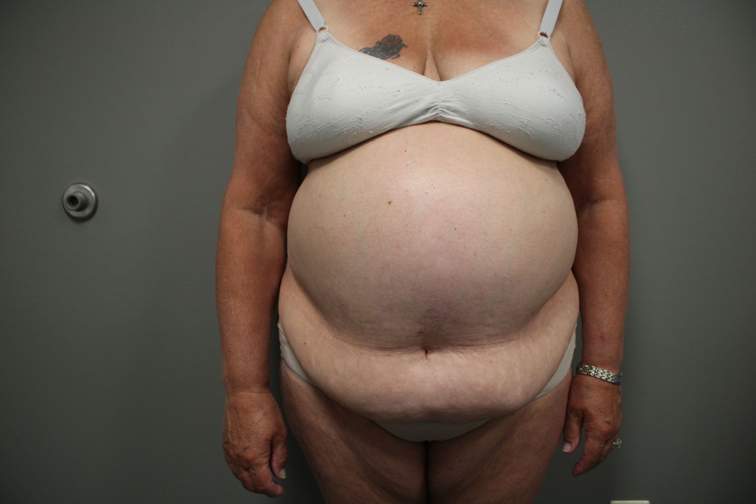 Tummy Tuck Before & After