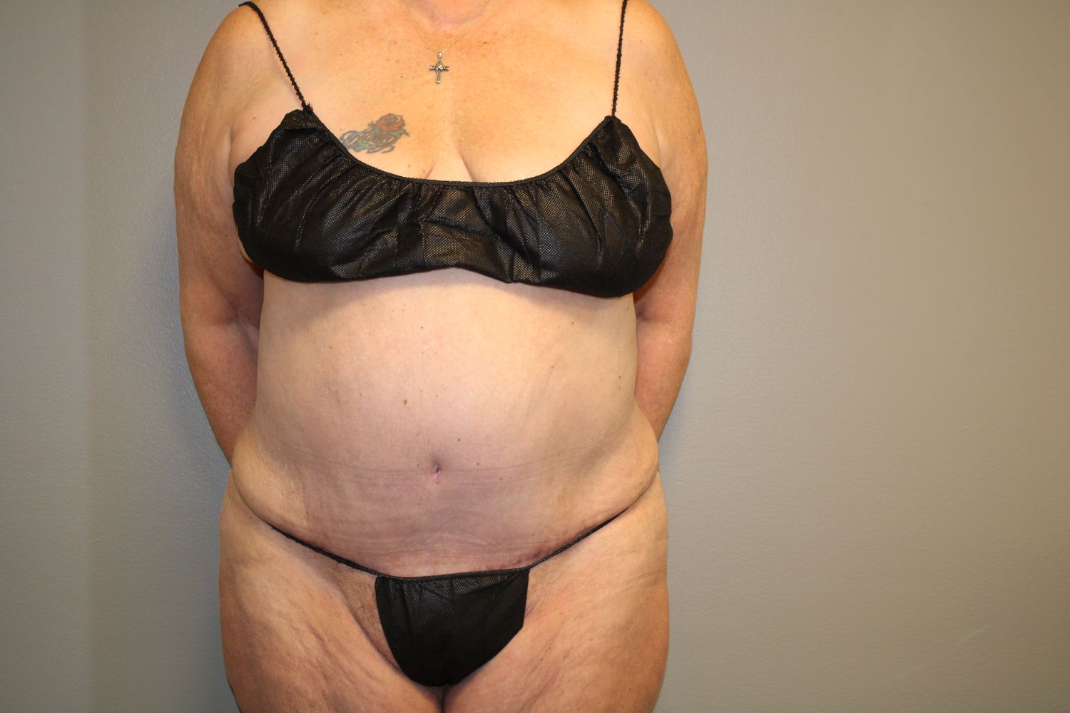 Tummy Tuck Before & After