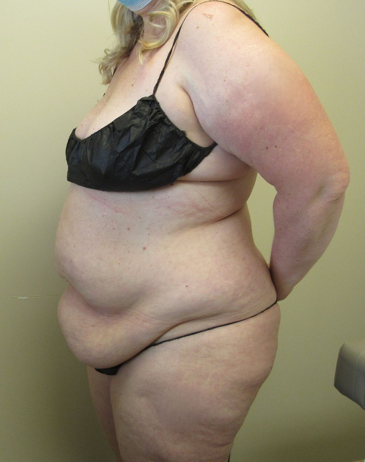 Tummy Tuck Before & After