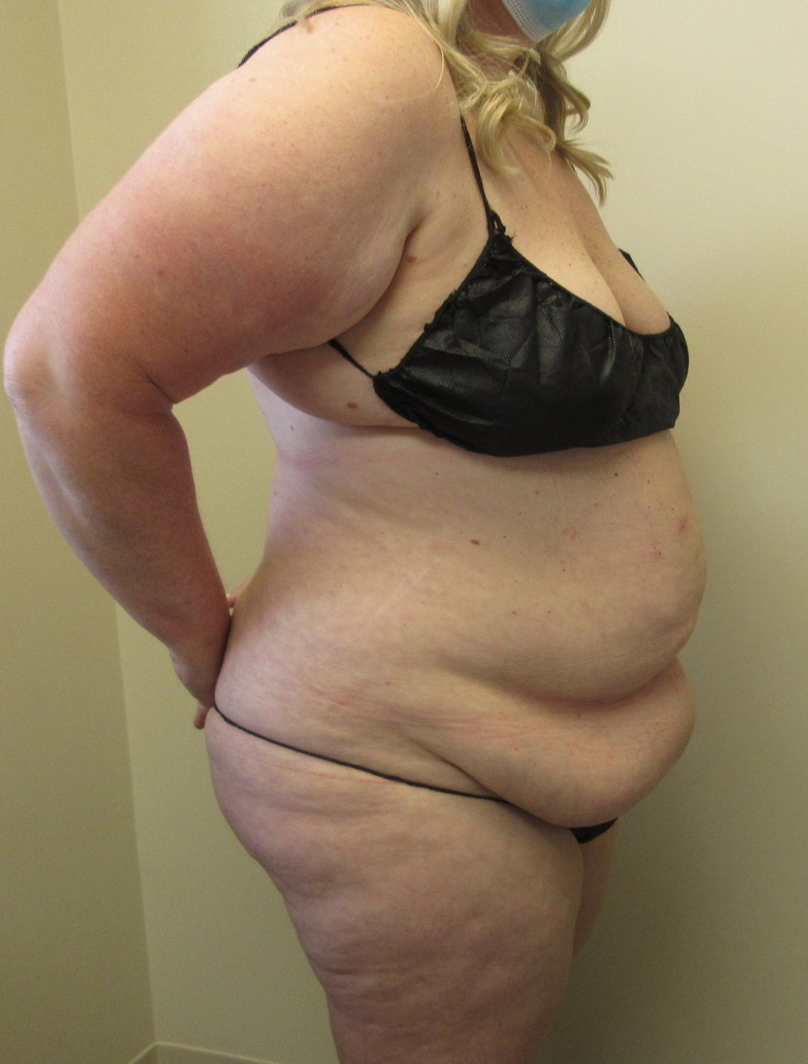 Tummy Tuck Before & After