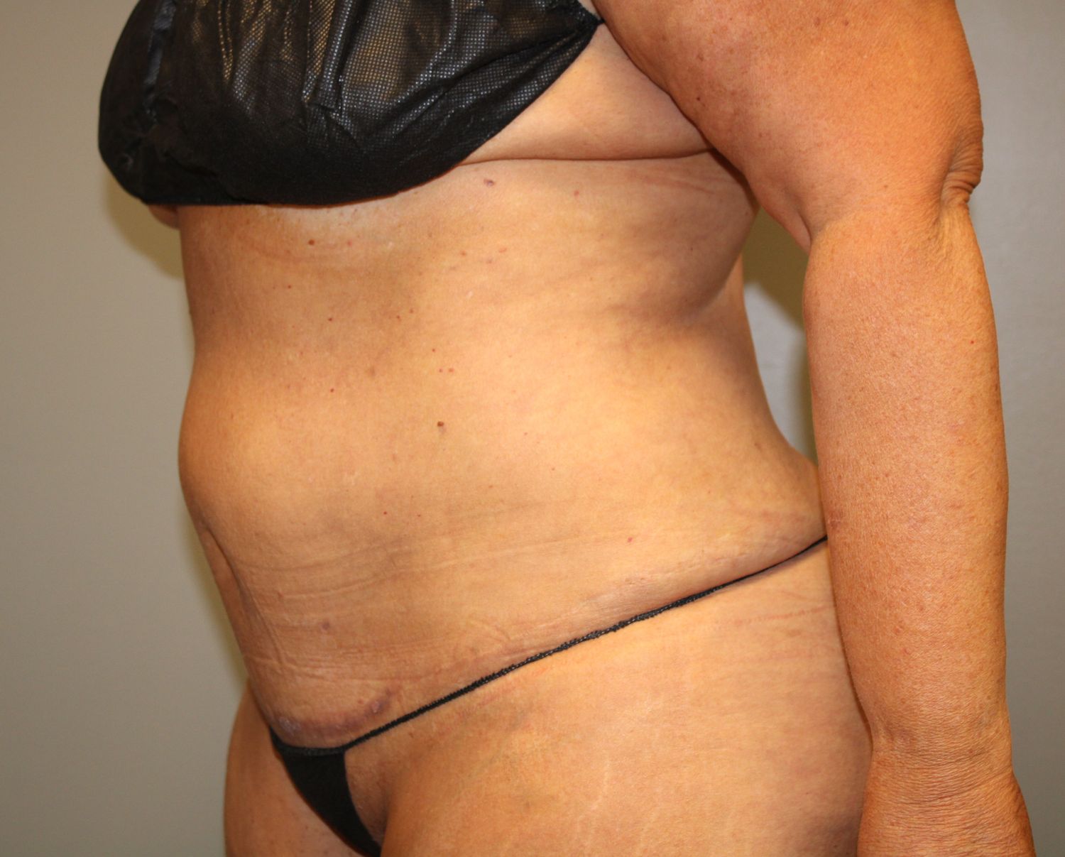 Tummy Tuck Before & After