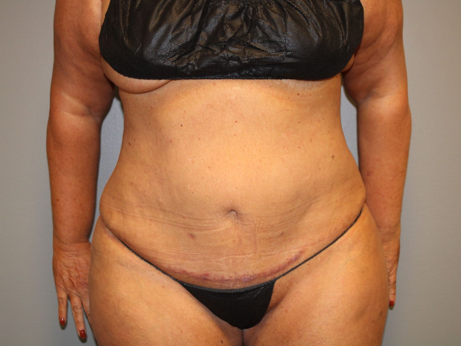Tummy Tuck Before & After