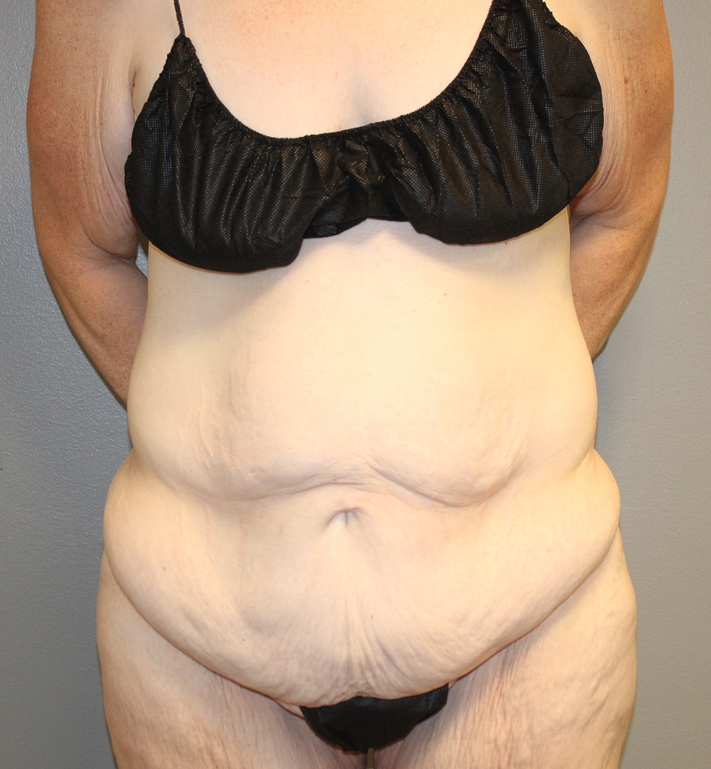 Tummy Tuck Before & After
