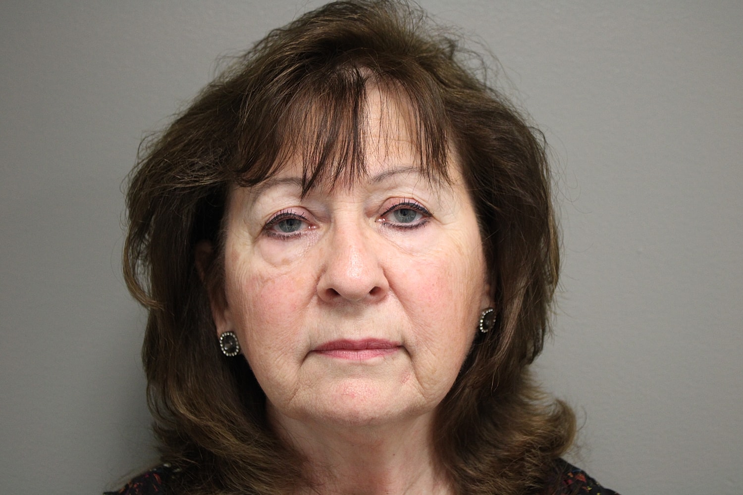 Blepharoplasty Before & After