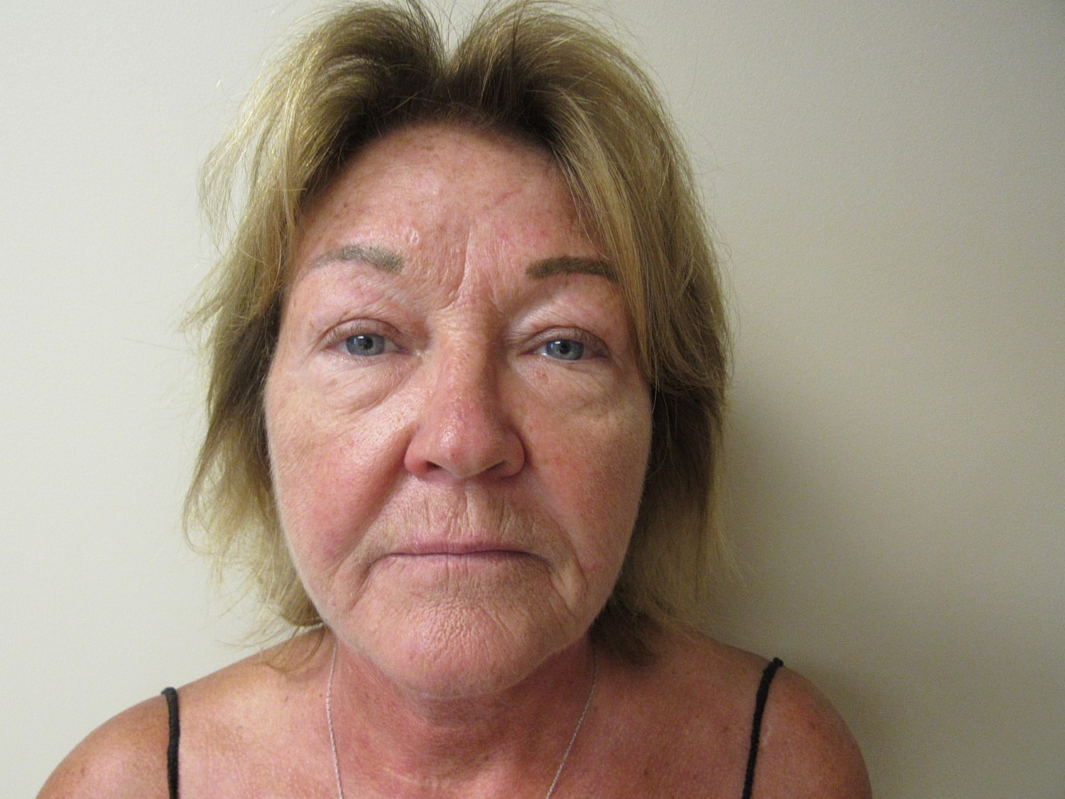 Fat Grafting and Filler Before & After