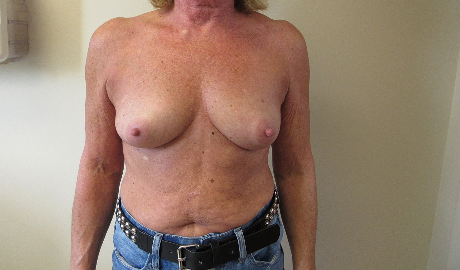 Breast Augmentation Before & After