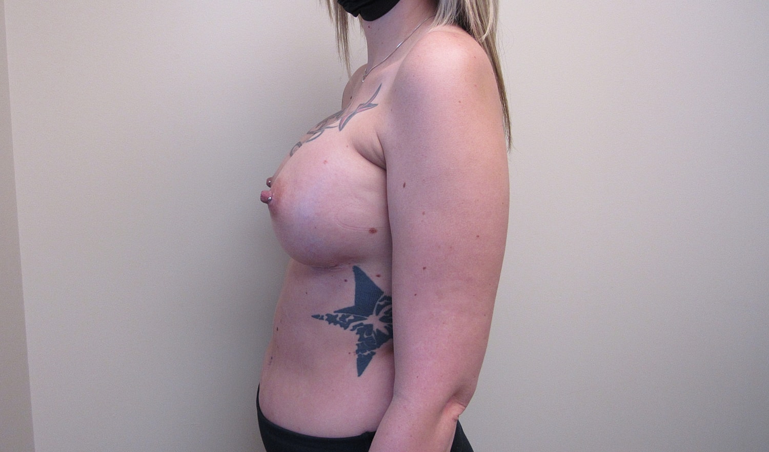 Breast Augmentation Before & After