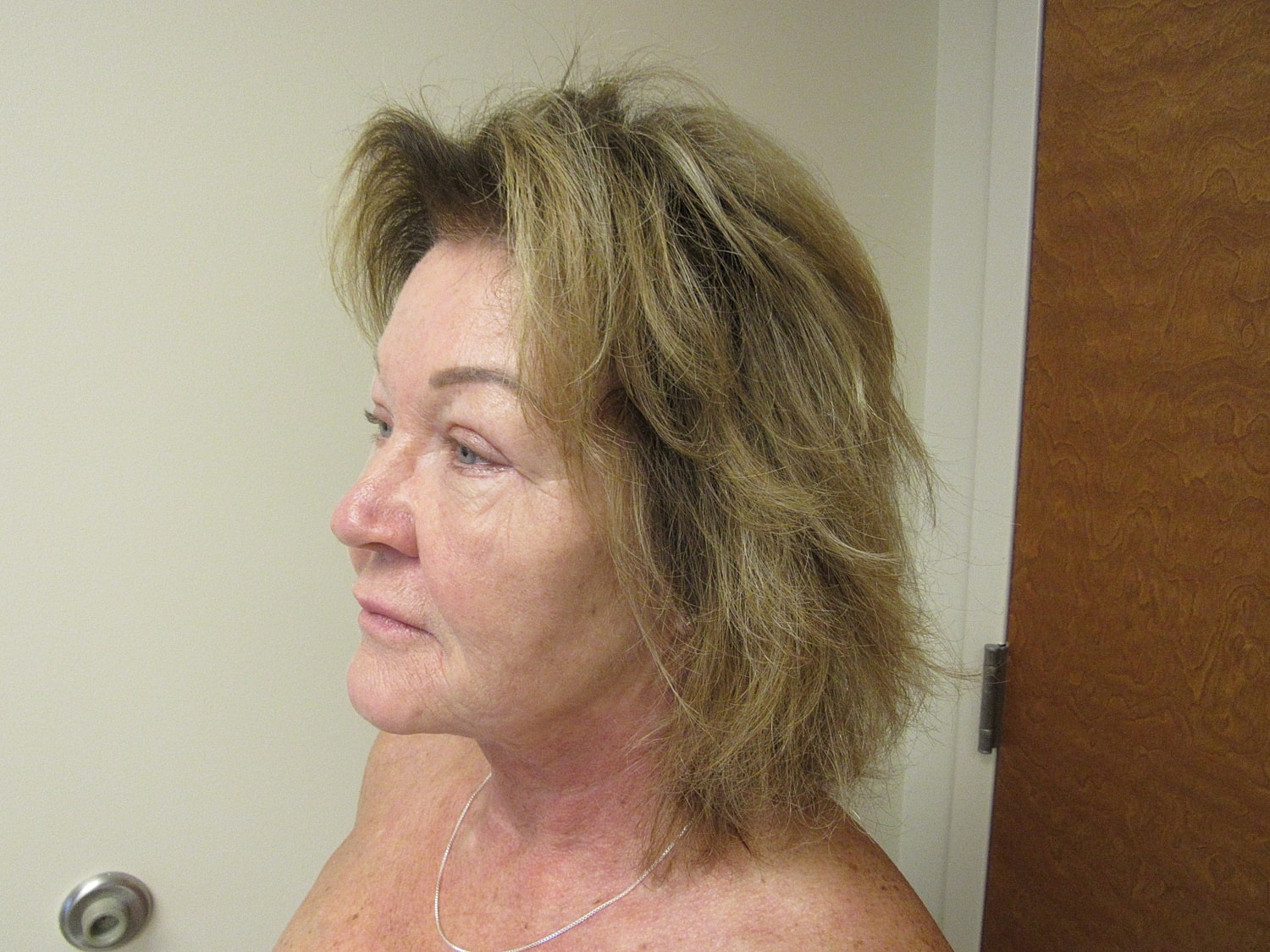 Fat Grafting and Filler Before & After